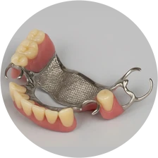 Cast partial 3D denture with metal framework