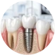 Straumann dental implants: illustration of an implant in the jawbone