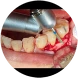 Osseous surgery on the gums and supporting bone