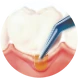 Periodontal chip surgery: illustration of gum treatment