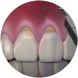 Pin-hole gum surgery: close-up of a restored gum line