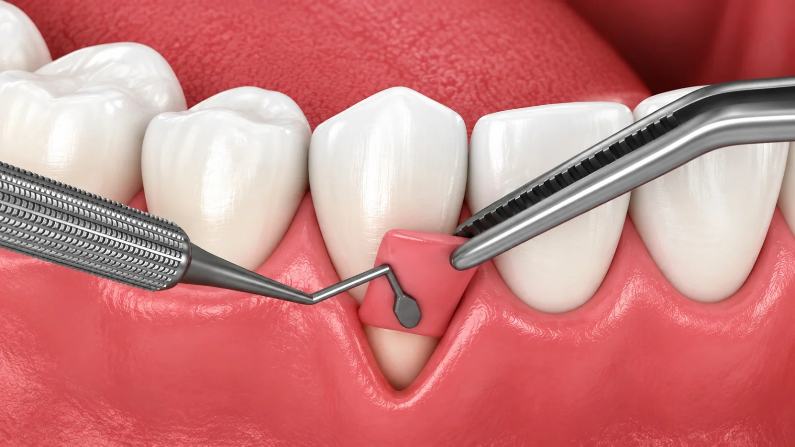Illustration of dental instruments treating a receded gum line above a lower front tooth